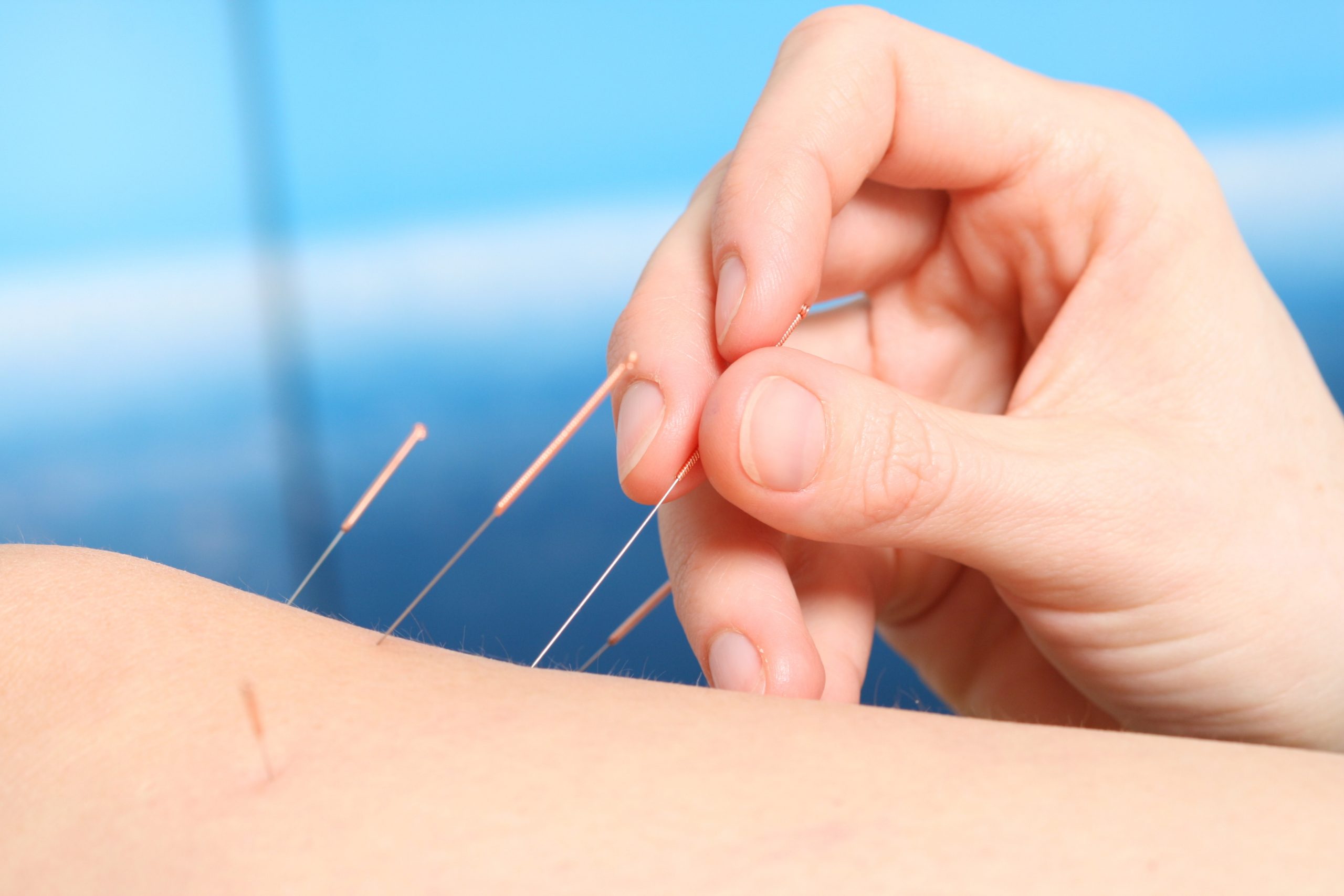 Scottsdale Electro Dry Needling by a Physical Therapist & Pricing