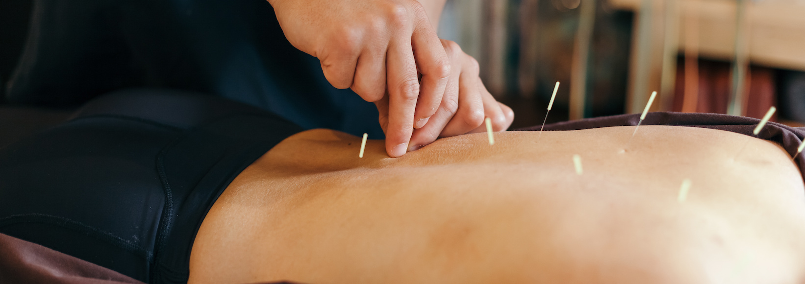 What is Dry Needling Really Like?